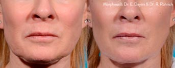 Morpheus8 Microneedling Fractional Treatment for Neck / Package prices available